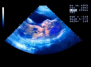 IVF success story in Lucknow, Best IVF in Lucknow, Blog Image